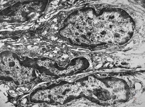 F,41y. | synovial metaplasia - capsule of implantate